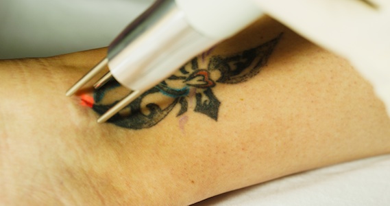 How Laser Tattoo Removal Works – UNBRANDED Austin Tattoo Removal
