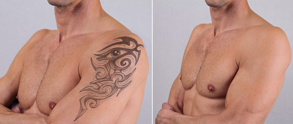 Laser Tattoo Removal in Austin, TX – UNBRANDED Austin Tattoo Removal