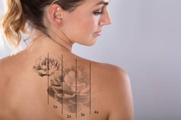 Laser Tattoo Removal for Tattoo Modification UNBRANDED