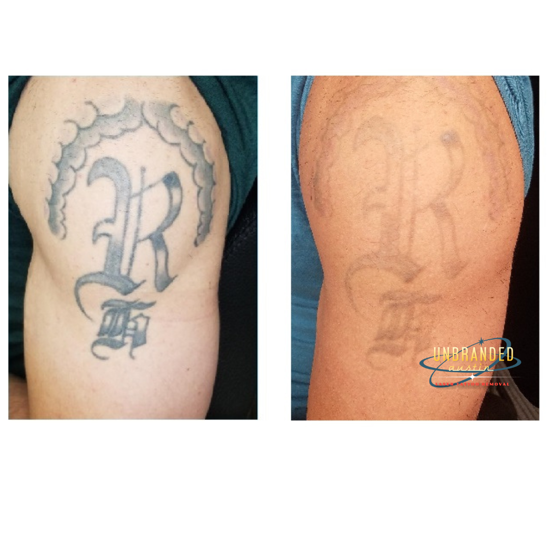 Before & After Results – UNBRANDED Austin Tattoo Removal