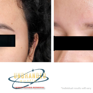 Permanent Makeup Removal of eyebrow inks - Before & After